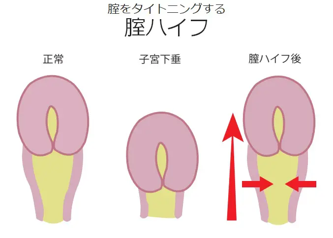 腟ハイフ｜女医女性スタッフの婦人科|まえだウィメンズケアクリニック｜膣ハイフ