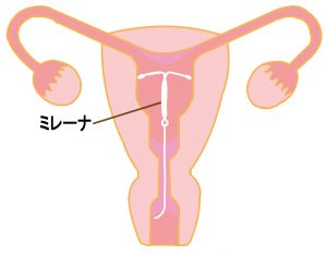 ミレーナ説明図