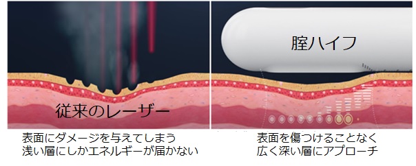 腟ハイフ｜女医女性スタッフの婦人科|まえだウィメンズケアクリニック｜膣ハイフ