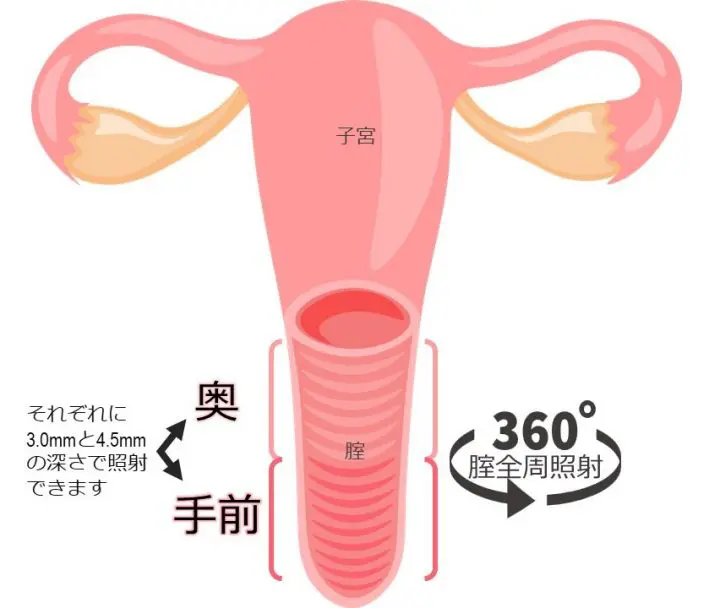 腟ハイフ｜女医女性スタッフの婦人科|まえだウィメンズケアクリニック｜膣ハイフ