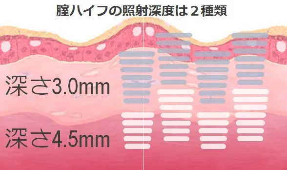 腟ハイフ｜女医女性スタッフの婦人科|まえだウィメンズケアクリニック｜膣ハイフ