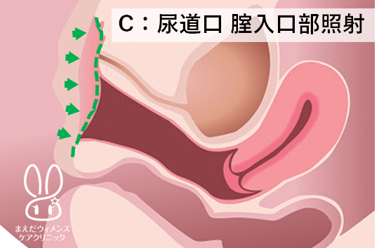 Cインティマレーザー尿道口腟入口部照射