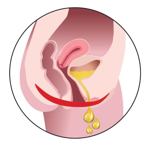 骨盤底筋の弱さが尿もれ症状の原因の一つとして知られています